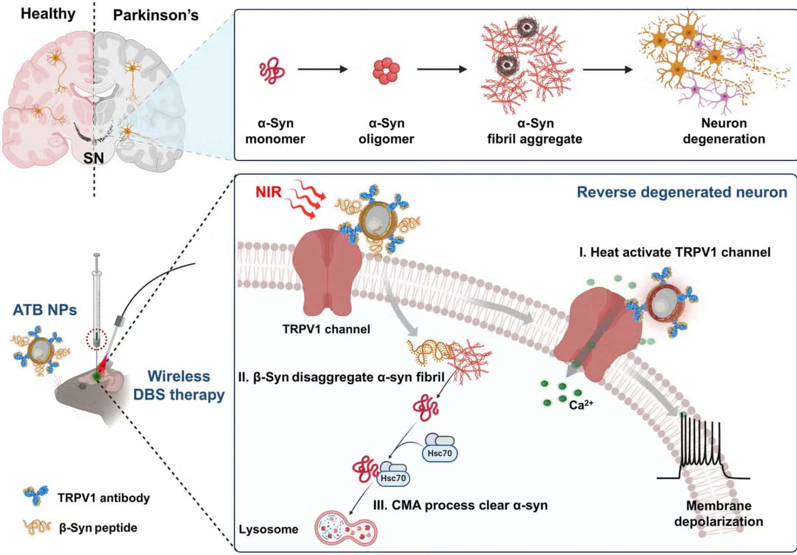 parkinsonova choroba