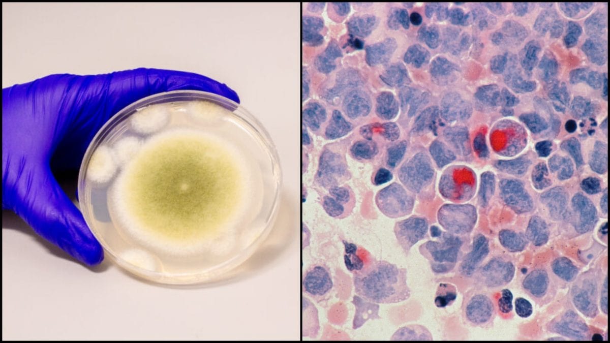 Aspergillus flavus v petriho miske a rakovinové bunky