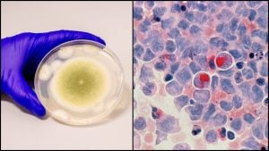 Aspergillus flavus v petriho miske a rakovinové bunky
