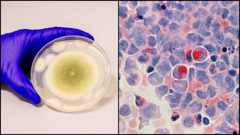 Aspergillus flavus v petriho miske a rakovinové bunky