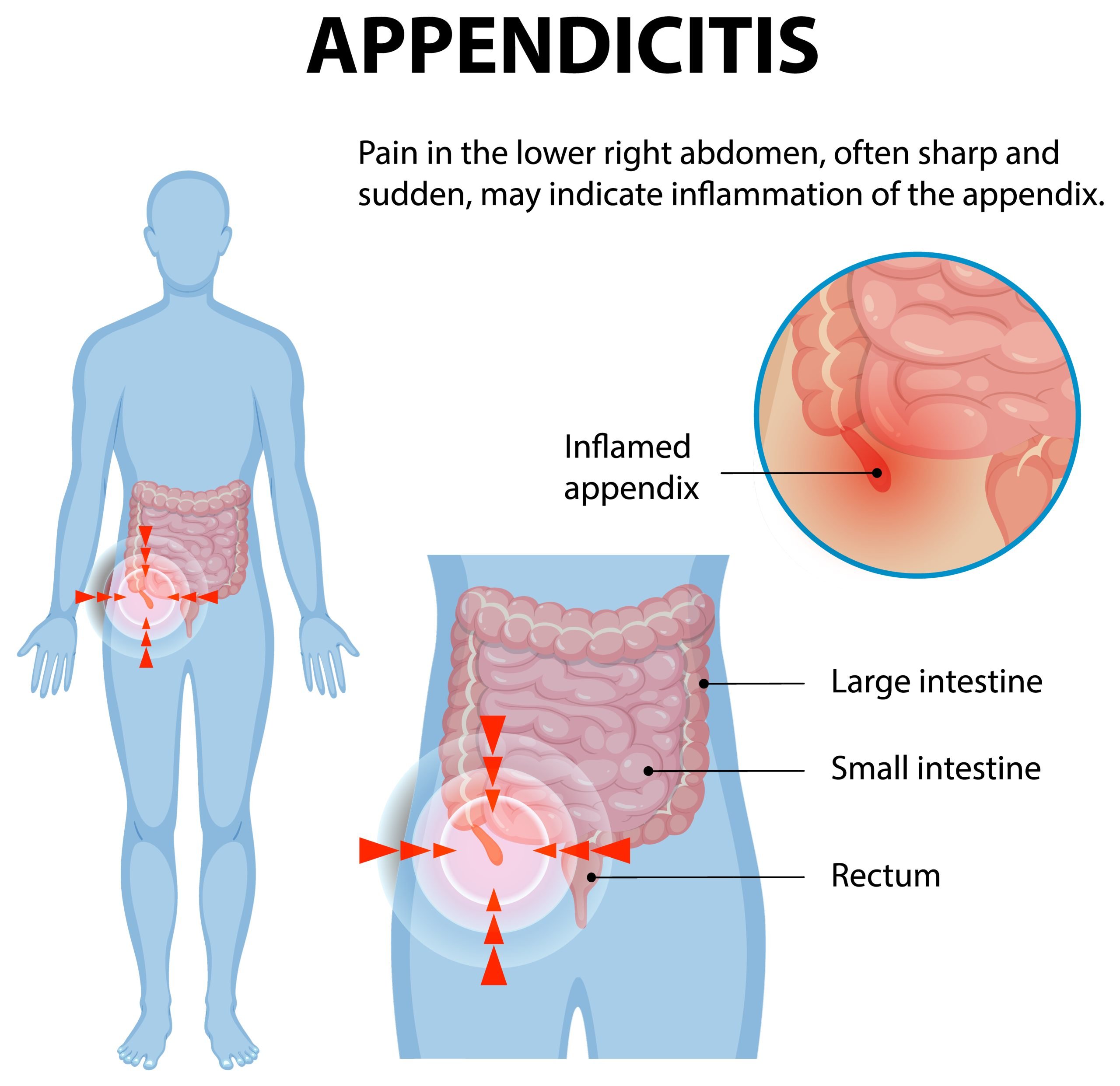 Illustration of inflamed appendix and abdominal pain