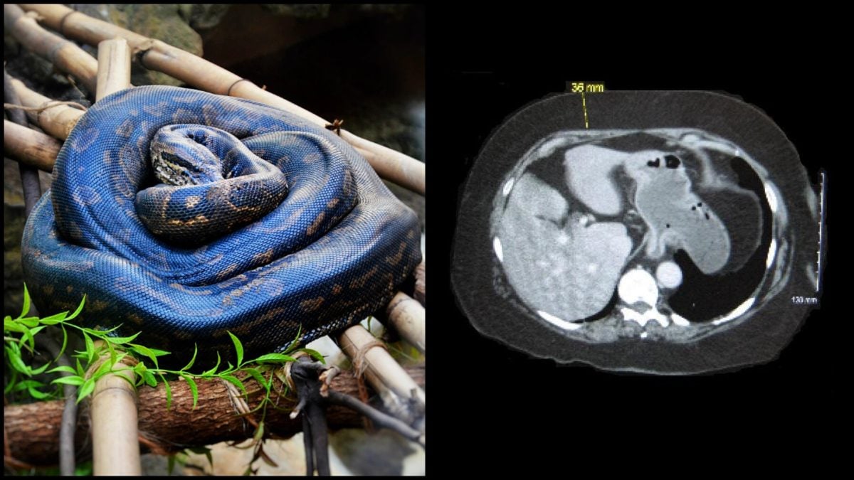 Had pomohol k liečeniu obezity